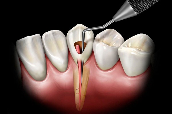 Как часто нужно посещать стоматолога, как проходит диагностика кариеса