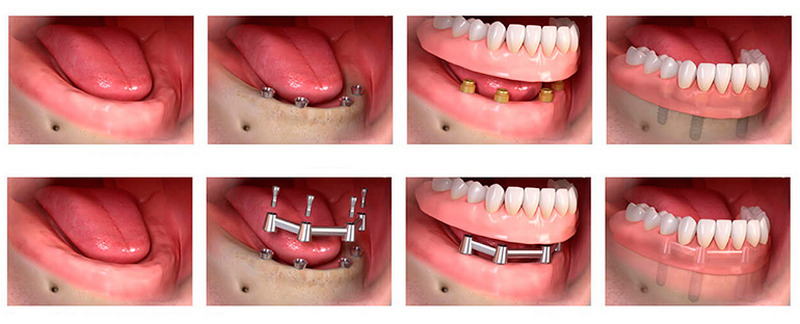 Имплантация зубов: все, что нужно знать, если Вы сомневаетесь