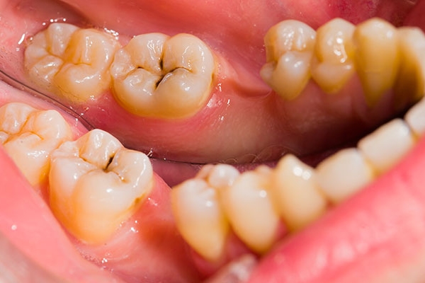 Нужно ли лечить кариес, если зубы не болят?