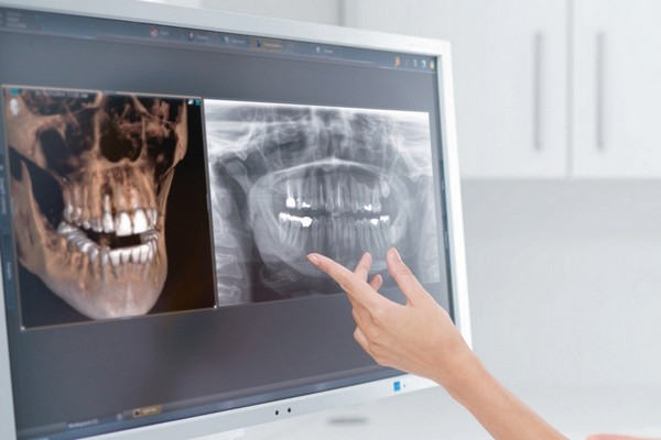 В чем преимущества томографии зубов перед классическим рентгеном