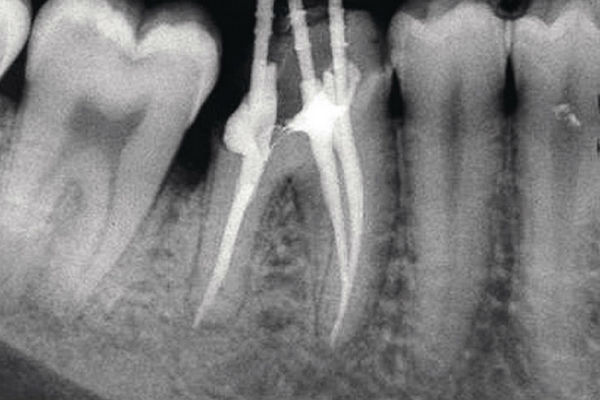 Лечение пульпита: как избавиться от боли и спасти зуб